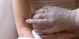 Инфекции кожи: что важно знать педиатру?